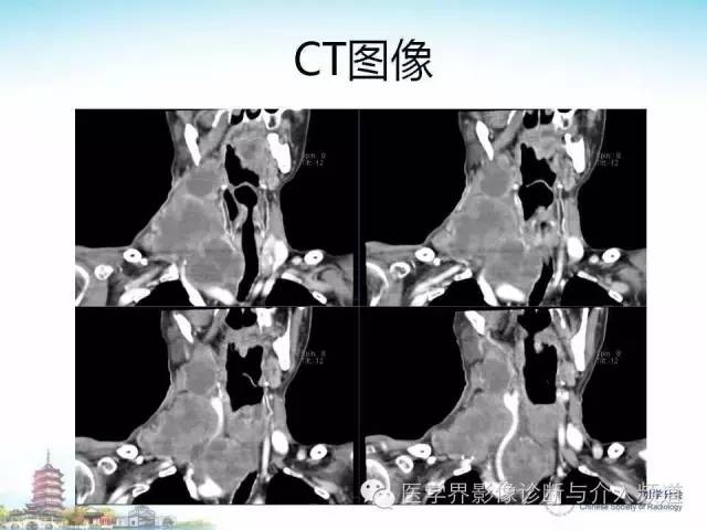 【病例】甲状腺未分化肉瘤1例CT影像表现