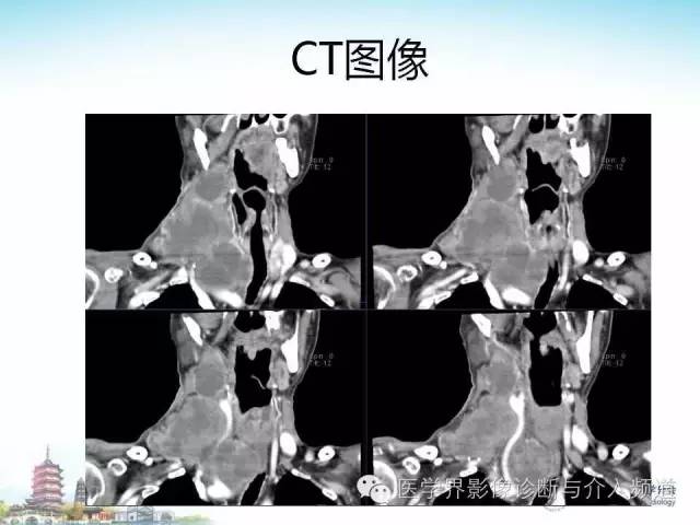 【病例】甲状腺未分化肉瘤1例CT影像表现