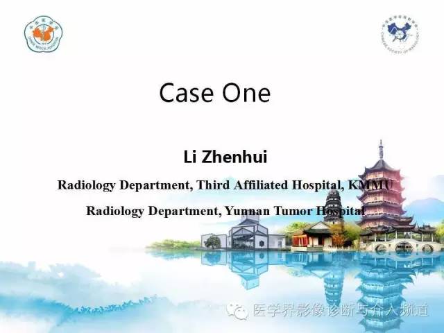 【病例】甲状腺未分化肉瘤1例CT影像表现