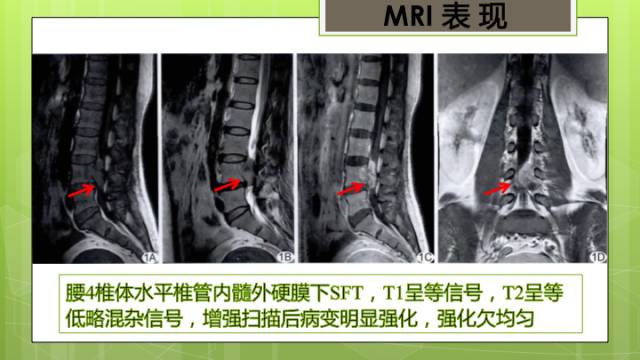 【病例】颈髓髓内孤立性纤维瘤1例MR分析