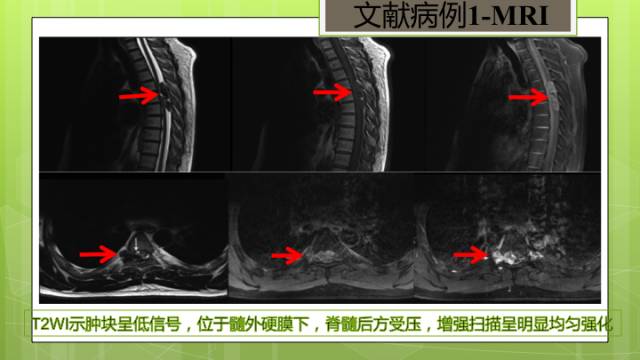【病例】颈髓髓内孤立性纤维瘤1例MR分析