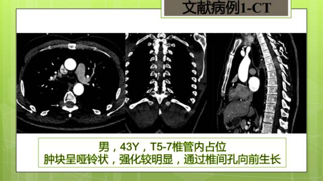 【病例】颈髓髓内孤立性纤维瘤1例MR分析