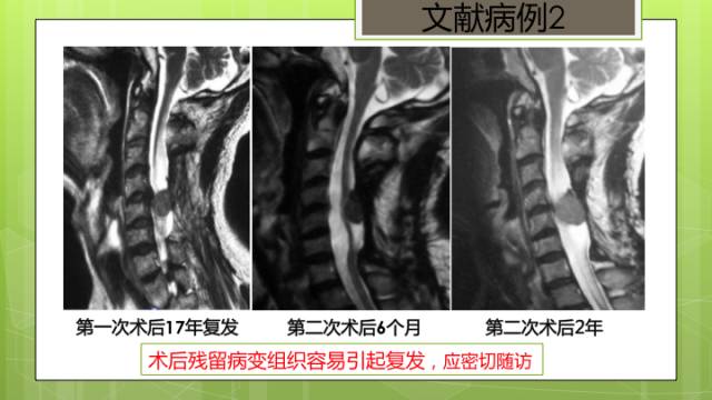 【病例】颈髓髓内孤立性纤维瘤1例MR分析