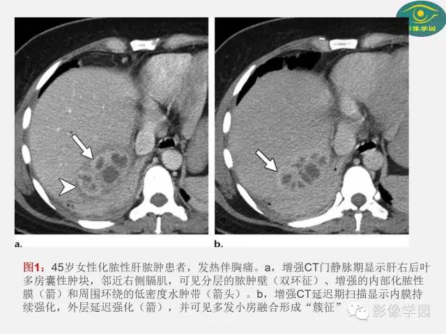 【PPT】肝脏感染性病变影像学鉴别诊断及潜在陷阱