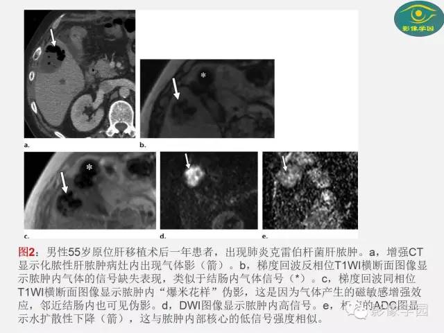【PPT】肝脏感染性病变影像学鉴别诊断及潜在陷阱