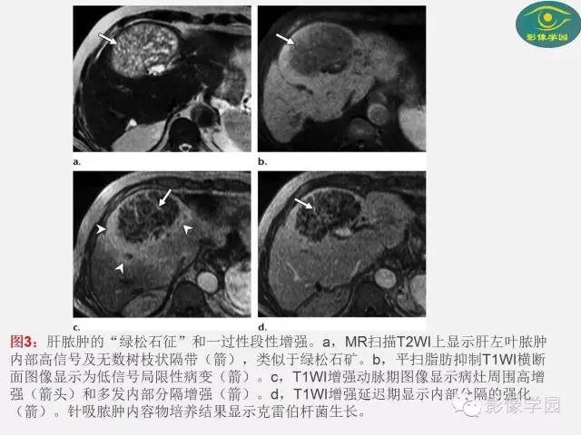 【PPT】肝脏感染性病变影像学鉴别诊断及潜在陷阱