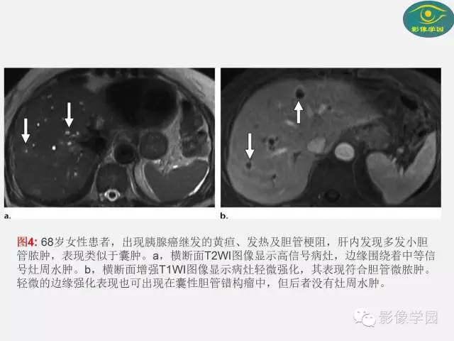 【PPT】肝脏感染性病变影像学鉴别诊断及潜在陷阱