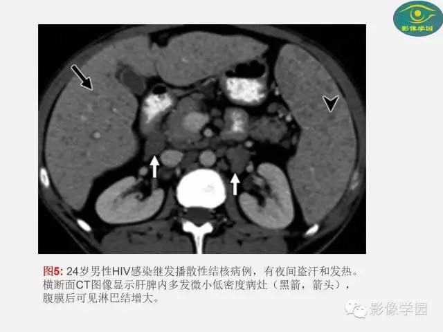 【PPT】肝脏感染性病变影像学鉴别诊断及潜在陷阱