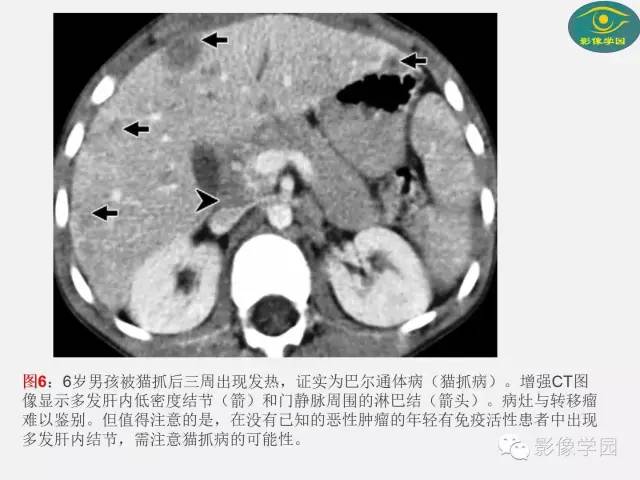 【PPT】肝脏感染性病变影像学鉴别诊断及潜在陷阱