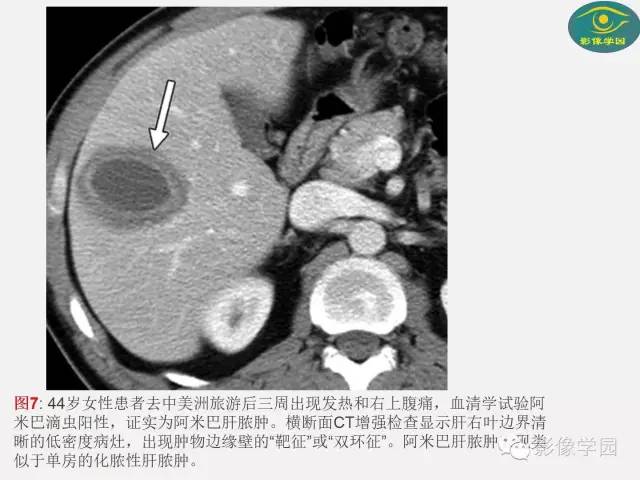 【PPT】肝脏感染性病变影像学鉴别诊断及潜在陷阱