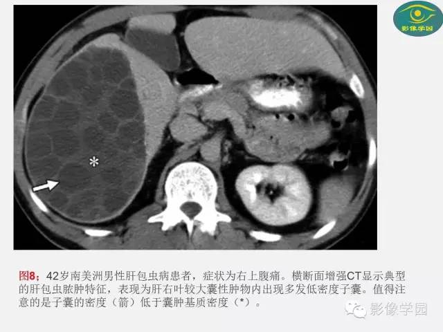 【PPT】肝脏感染性病变影像学鉴别诊断及潜在陷阱