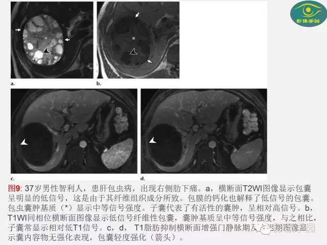 【PPT】肝脏感染性病变影像学鉴别诊断及潜在陷阱