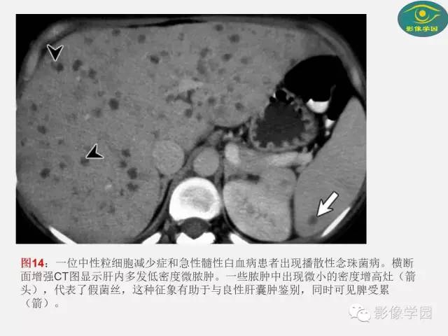 【PPT】肝脏感染性病变影像学鉴别诊断及潜在陷阱