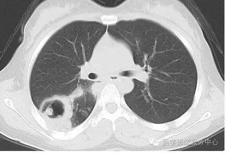 【病例】肺部空洞性病灶，你能确诊吗？