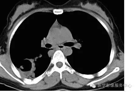 【病例】肺部空洞性病灶,你能确诊吗? 【病例】肺部空洞性病灶,你能确诊吗?