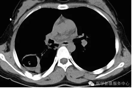 【病例】肺部空洞性病灶,你能确诊吗? 【病例】肺部空洞性病灶,你能确诊吗?
