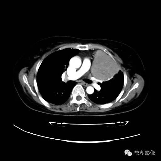 【病例】胸腺瘤1例CT影像表现 【病例】胸腺瘤1例CT影像表现