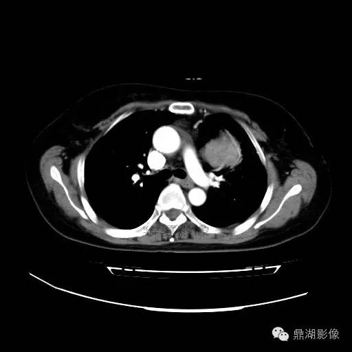 【病例】胸腺瘤1例CT影像表现 【病例】胸腺瘤1例CT影像表现