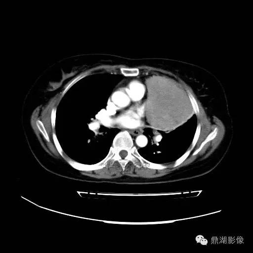 【病例】胸腺瘤1例CT影像表现 【病例】胸腺瘤1例CT影像表现