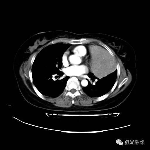 【病例】胸腺瘤1例CT影像表现 【病例】胸腺瘤1例CT影像表现