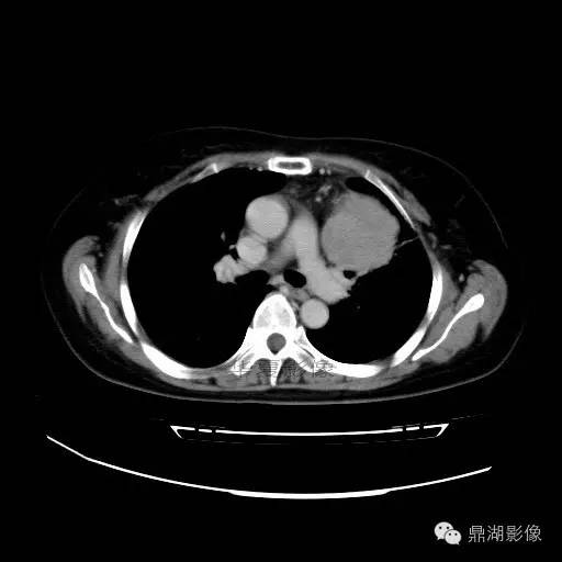 【病例】胸腺瘤1例CT影像表现 【病例】胸腺瘤1例CT影像表现