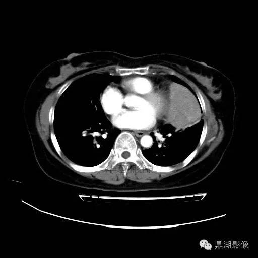 【病例】胸腺瘤1例CT影像表现 【病例】胸腺瘤1例CT影像表现