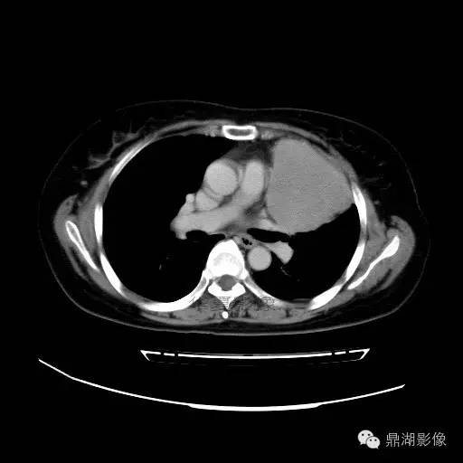 【病例】胸腺瘤1例CT影像表现 【病例】胸腺瘤1例CT影像表现