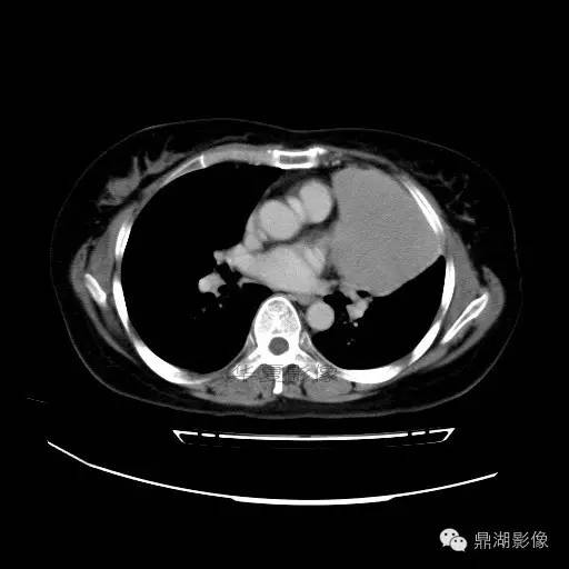 【病例】胸腺瘤1例CT影像表现 【病例】胸腺瘤1例CT影像表现
