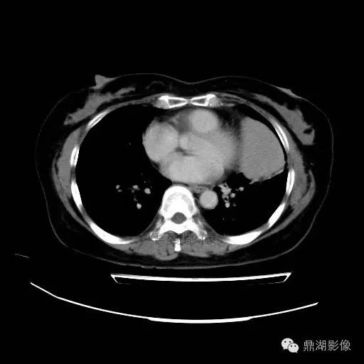【病例】胸腺瘤1例CT影像表现 【病例】胸腺瘤1例CT影像表现