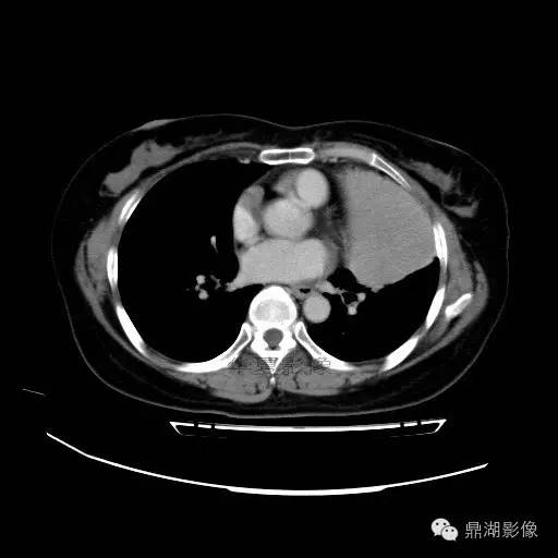 【病例】胸腺瘤1例CT影像表现 【病例】胸腺瘤1例CT影像表现