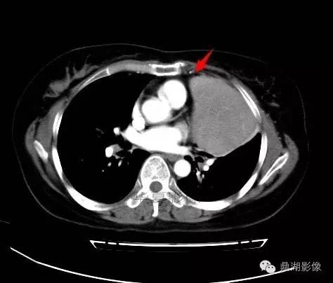 【病例】胸腺瘤1例CT影像表现 【病例】胸腺瘤1例CT影像表现