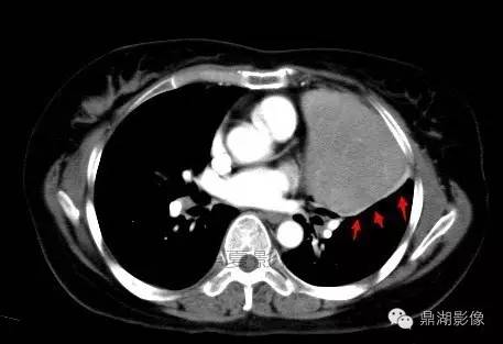 【病例】胸腺瘤1例CT影像表现 【病例】胸腺瘤1例CT影像表现
