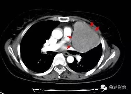 【病例】胸腺瘤1例CT影像表现 【病例】胸腺瘤1例CT影像表现