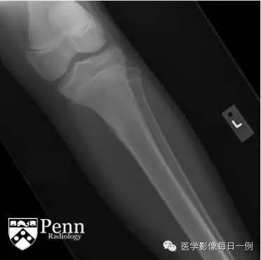 【病例】胫骨干骺端骨样骨瘤1例X线及MR影像表现