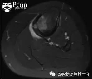 【病例】胫骨干骺端骨样骨瘤1例X线及MR影像表现