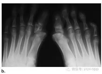 儿童成纤维性及成肌纤维性肿瘤的影像诊断 儿童成纤维性及成肌纤维性肿瘤的影像诊断