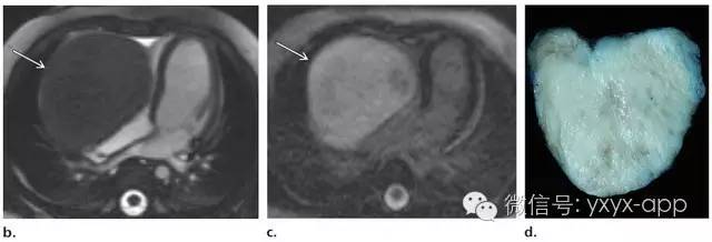 儿童成纤维性及成肌纤维性肿瘤的影像诊断 儿童成纤维性及成肌纤维性肿瘤的影像诊断
