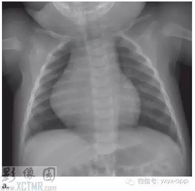 儿童成纤维性及成肌纤维性肿瘤的影像诊断 儿童成纤维性及成肌纤维性肿瘤的影像诊断