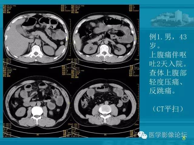 【PPT】小肠炎症性病变CT诊断
