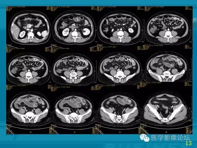 【PPT】小肠炎症性病变CT诊断