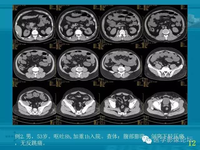 【PPT】小肠炎症性病变CT诊断