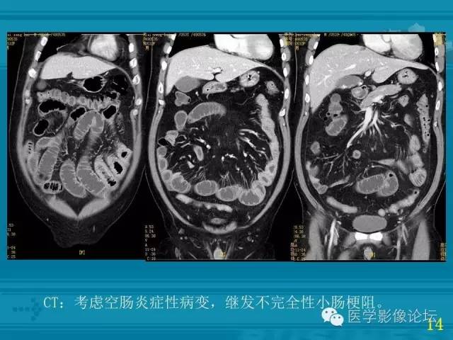 【PPT】小肠炎症性病变CT诊断