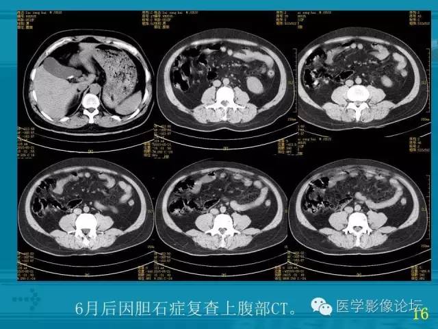 【PPT】小肠炎症性病变CT诊断