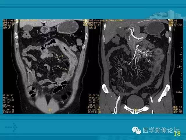 【PPT】小肠炎症性病变CT诊断