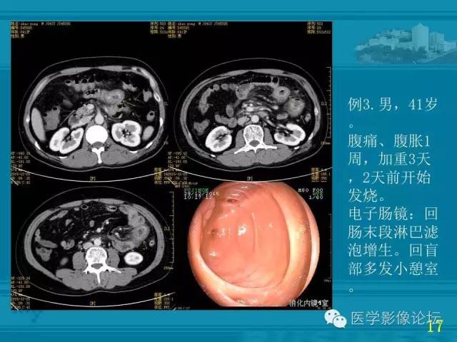 【PPT】小肠炎症性病变CT诊断