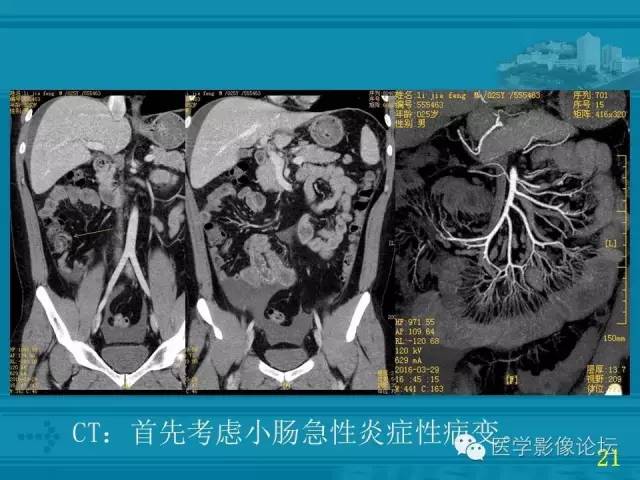 【PPT】小肠炎症性病变CT诊断
