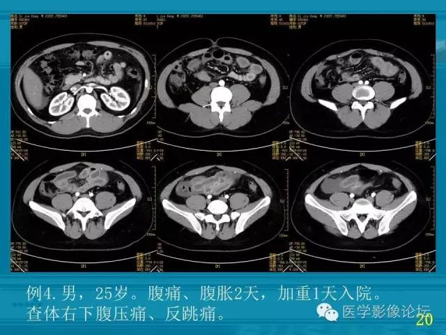 【PPT】小肠炎症性病变CT诊断