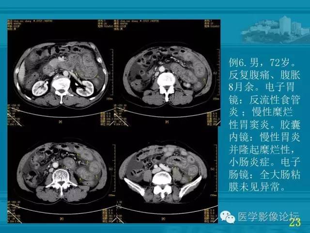 【PPT】小肠炎症性病变CT诊断