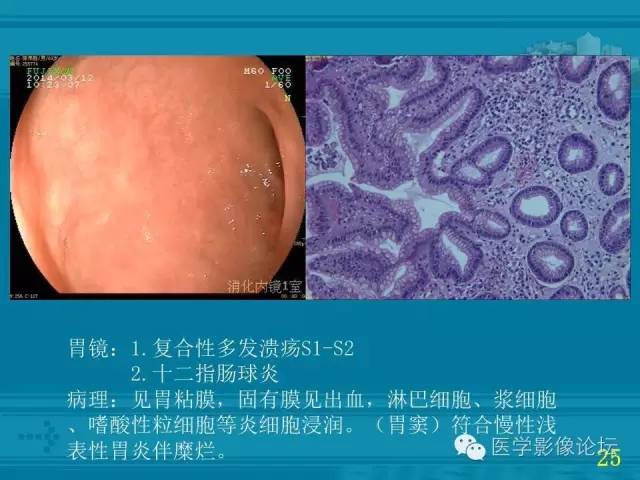 【PPT】小肠炎症性病变CT诊断