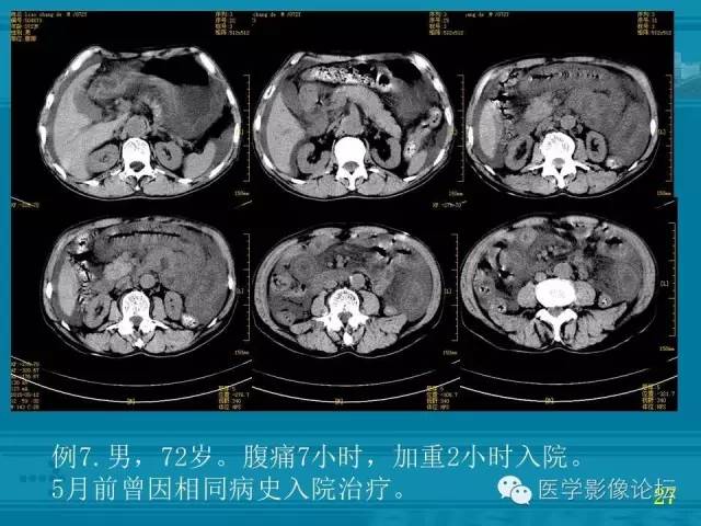 【PPT】小肠炎症性病变CT诊断